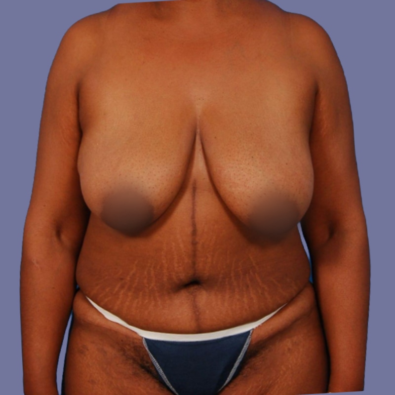 Breast Augmentation Before & After Image
