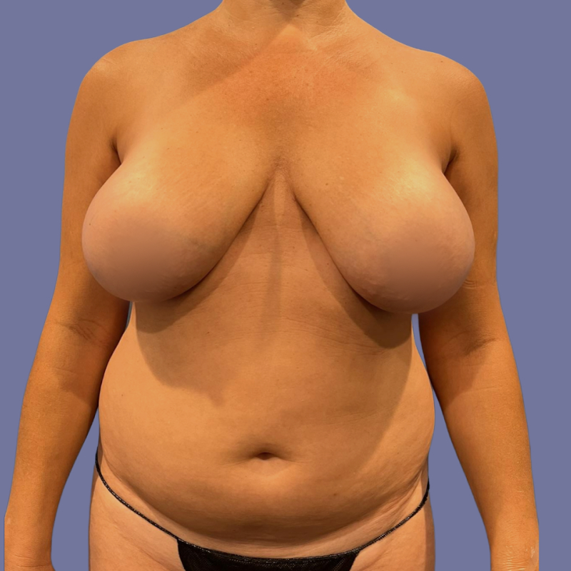 Breast Augmentation Before & After Image