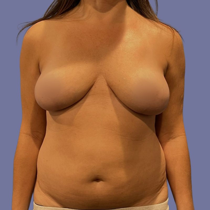 Breast Augmentation Before & After Image