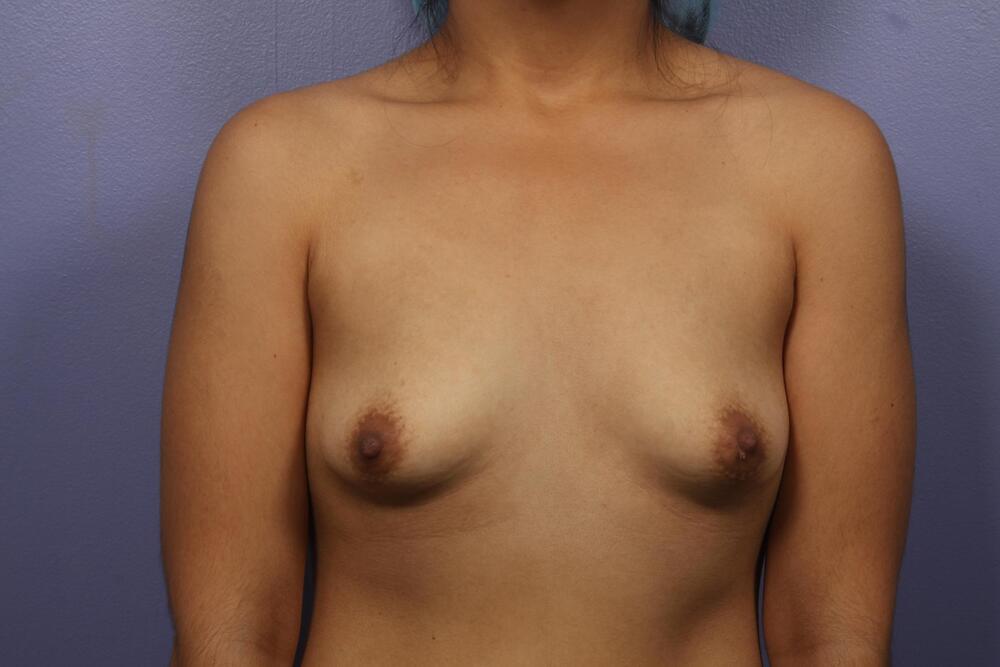 Breast Augmentation Before & After Image