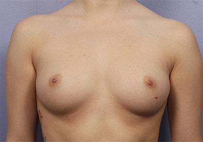 Breast Augmentation Before & After Image