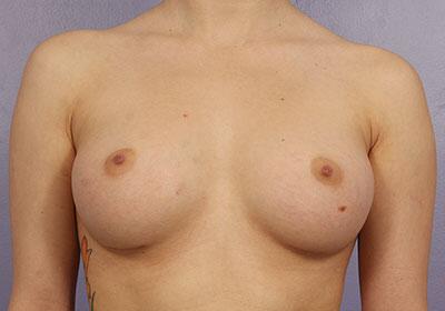 Breast Augmentation Before & After Image