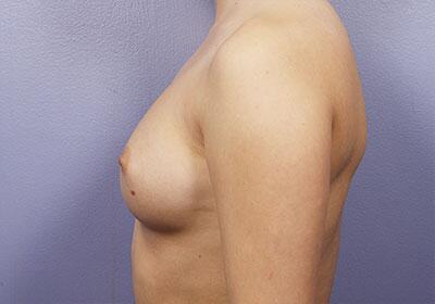 Breast Augmentation Before & After Image