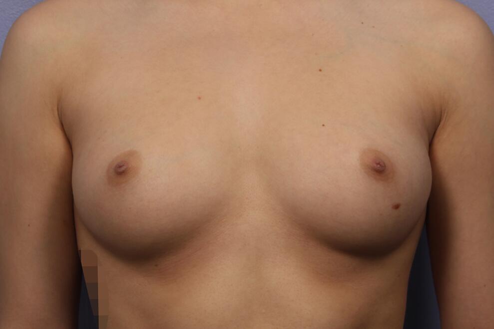 Breast Augmentation Before & After Image