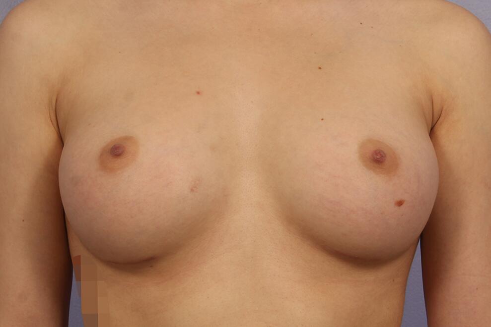 Breast Augmentation Before & After Image