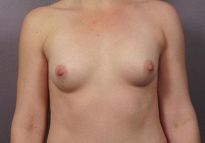 Breast Augmentation Before & After Image