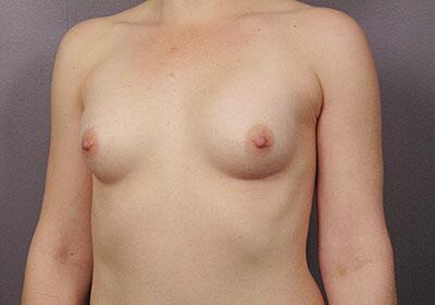 Breast Augmentation Before & After Image