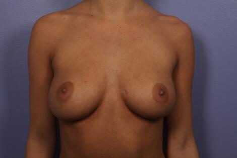 Breast Augmentation Before & After Image