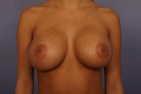 Breast Augmentation Before & After Image