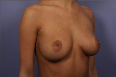 Breast Augmentation Before & After Image