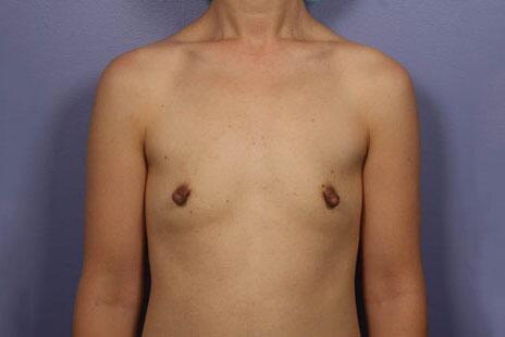 Breast Augmentation Before & After Image