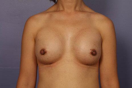 Breast Augmentation Before & After Image