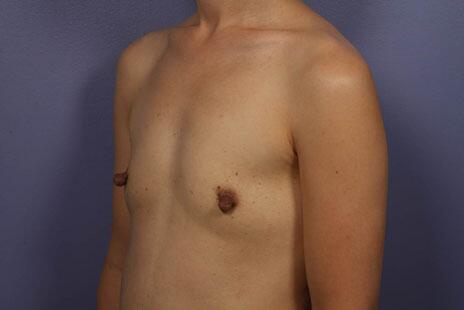 Breast Augmentation Before & After Image