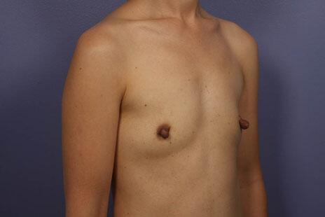 Breast Augmentation Before & After Image