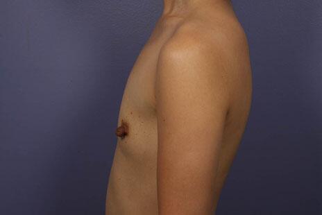 Breast Augmentation Before & After Image