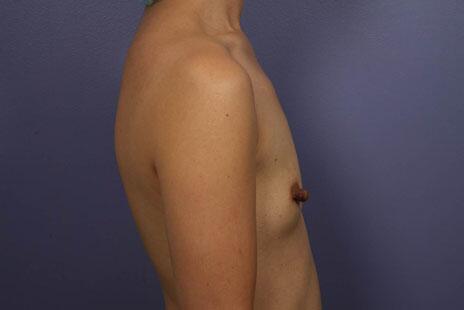 Breast Augmentation Before & After Image