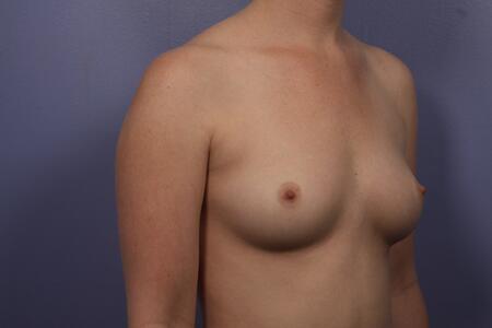 Breast Augmentation Before & After Image