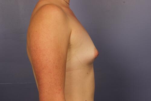 Breast Augmentation Before & After Image