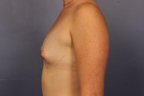 Breast Augmentation Before & After Image