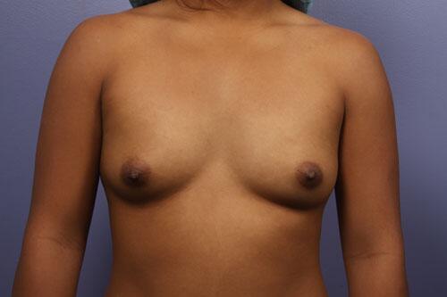 Breast Augmentation Before & After Image