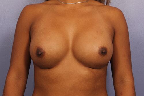 Breast Augmentation Before & After Image