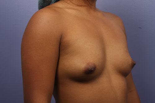 Breast Augmentation Before & After Image