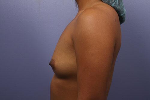 Breast Augmentation Before & After Image