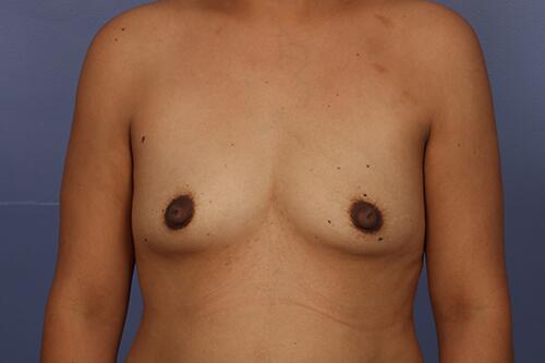 Breast Augmentation Before & After Image