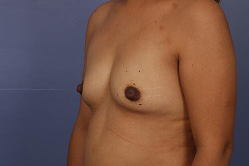 Breast Augmentation Before & After Image