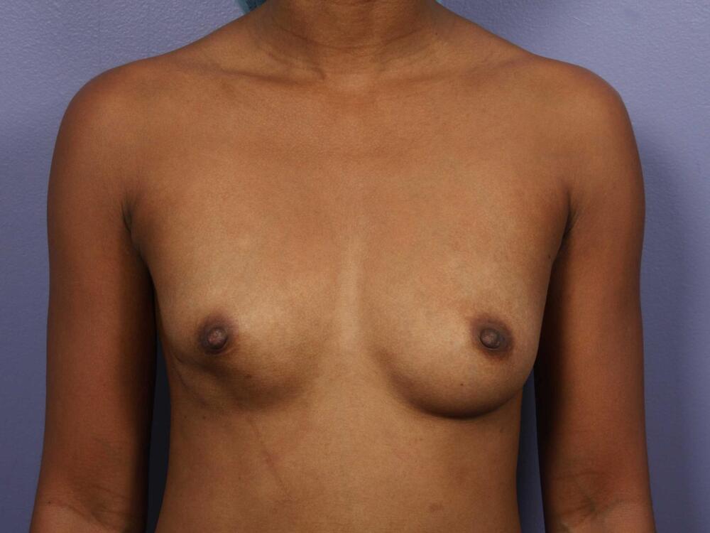 Breast Augmentation Before & After Image