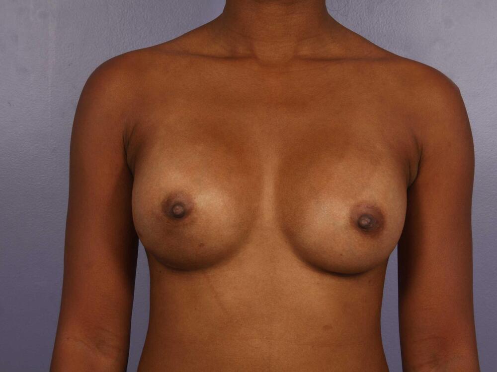 Breast Augmentation Before & After Image