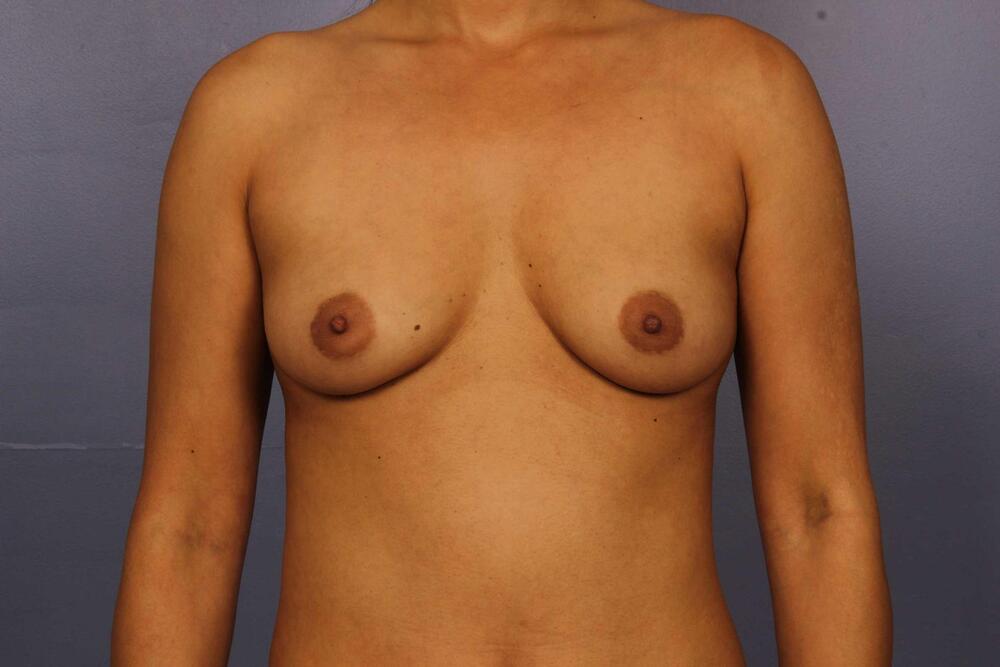 Breast Augmentation Before & After Image