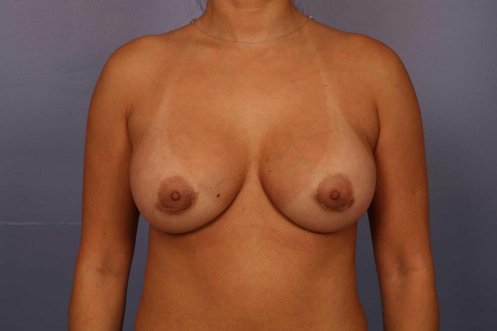 Breast Augmentation Before & After Image