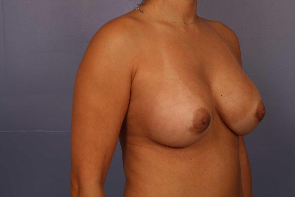 Breast Augmentation Before & After Image