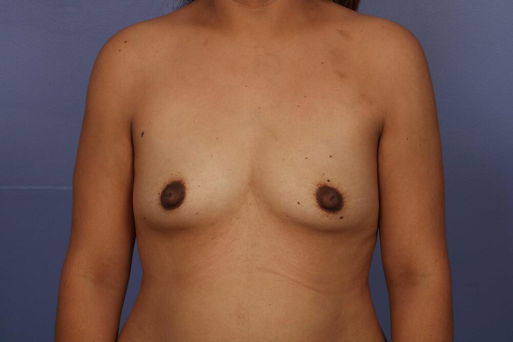 Breast Augmentation Before & After Image