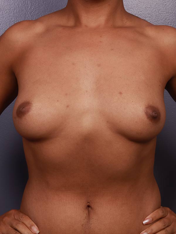 Breast Augmentation Before & After Image