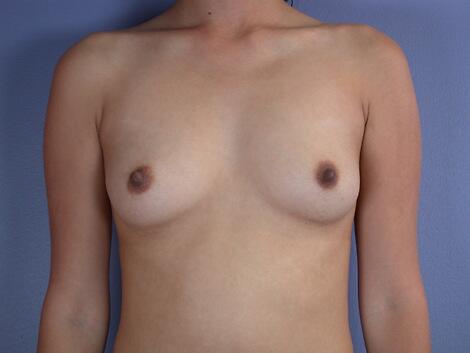 Breast Augmentation Before & After Image