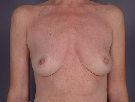 Breast Augmentation Before & After Image