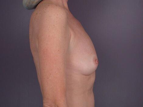 Breast Augmentation Before & After Image