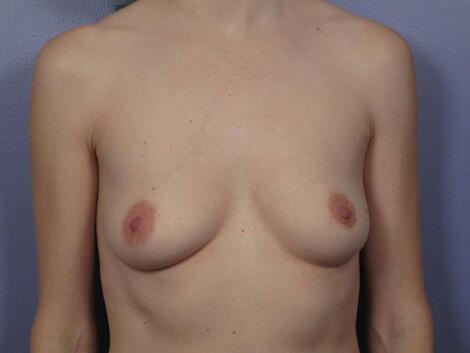 Breast Augmentation Before & After Image