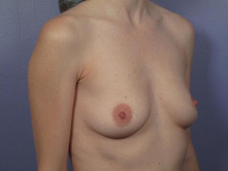 Breast Augmentation Before & After Image