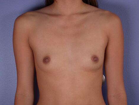 Breast Augmentation Before & After Image