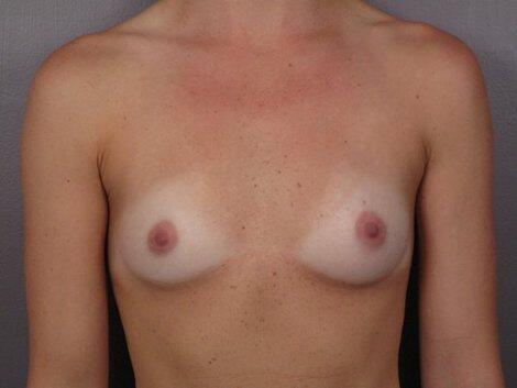 Breast Augmentation Before & After Image