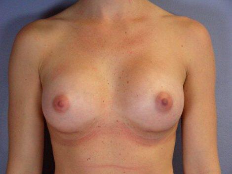 Breast Augmentation Before & After Image