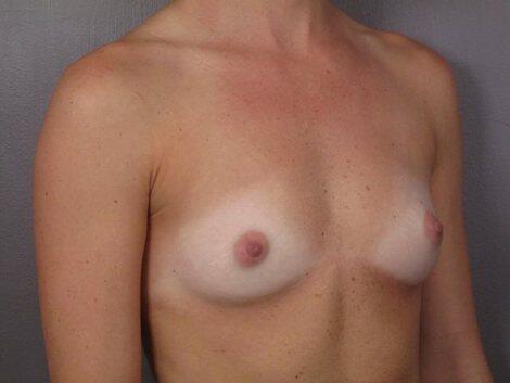 Breast Augmentation Before & After Image