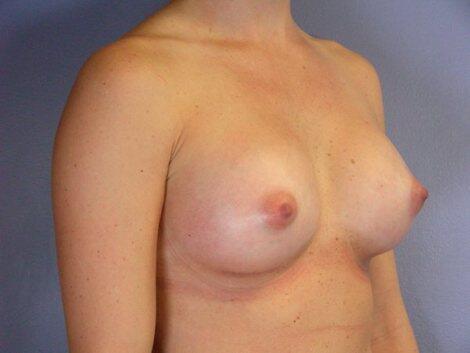 Breast Augmentation Before & After Image