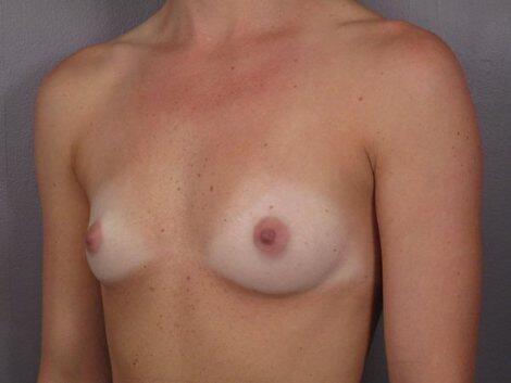 Breast Augmentation Before & After Image