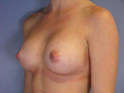 Breast Augmentation Before & After Image