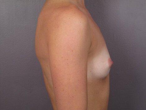 Breast Augmentation Before & After Image