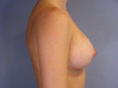 Breast Augmentation Before & After Image